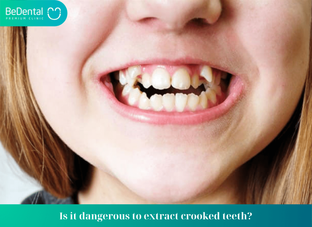 Should crooked teeth be extracted