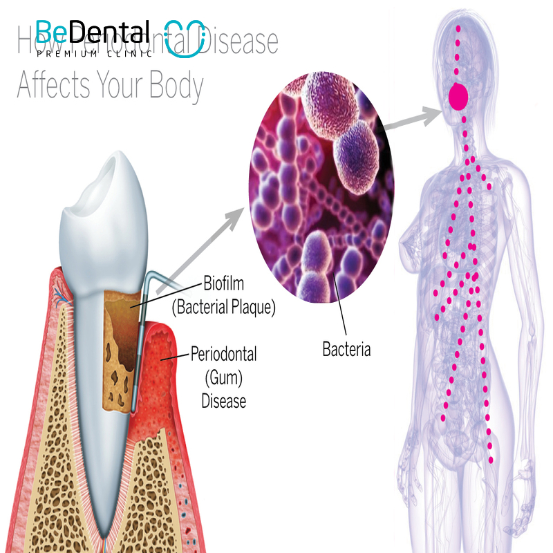 The link between periodontal disease and systemic conditions