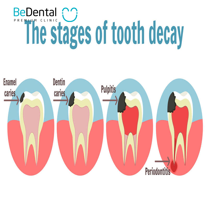 stages of tooth decay