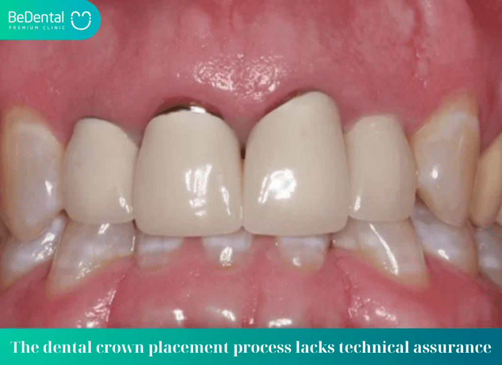 The dental crown placement process lacks technical assurance