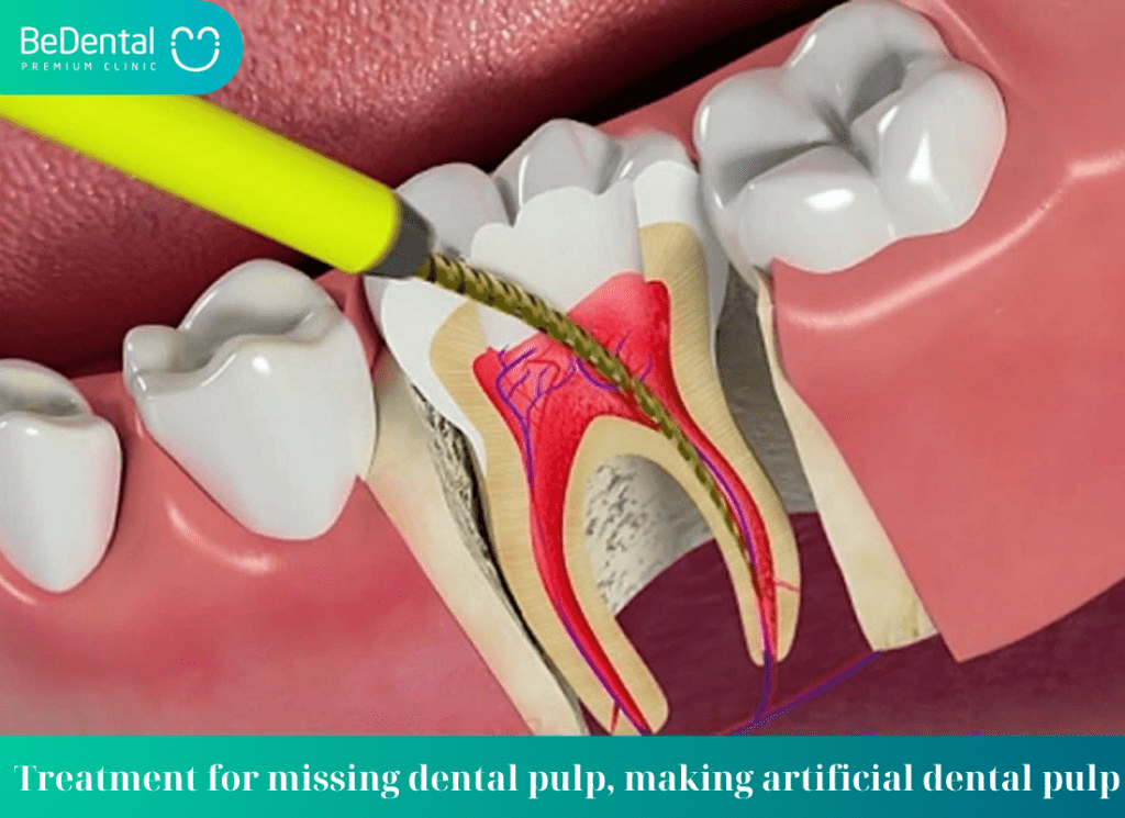 Treatment for missing dental pulp making artificial dental pulp