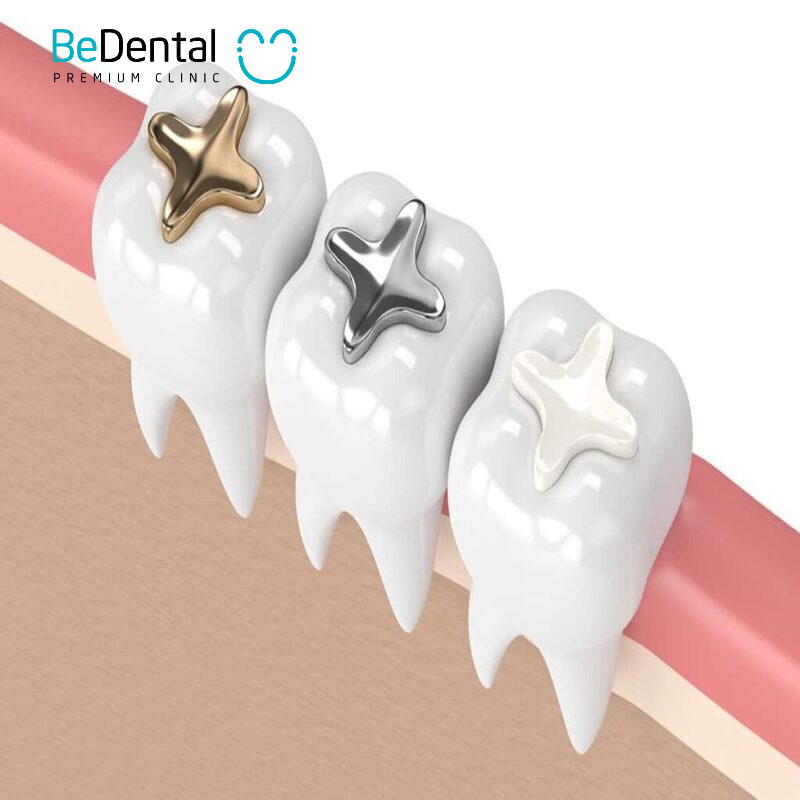 types of dental filling materials