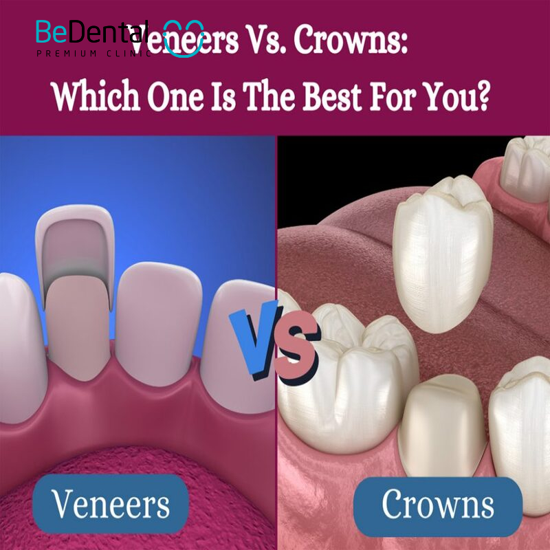 Veneers vs Dental Crowns: Which Option Is Right for You?