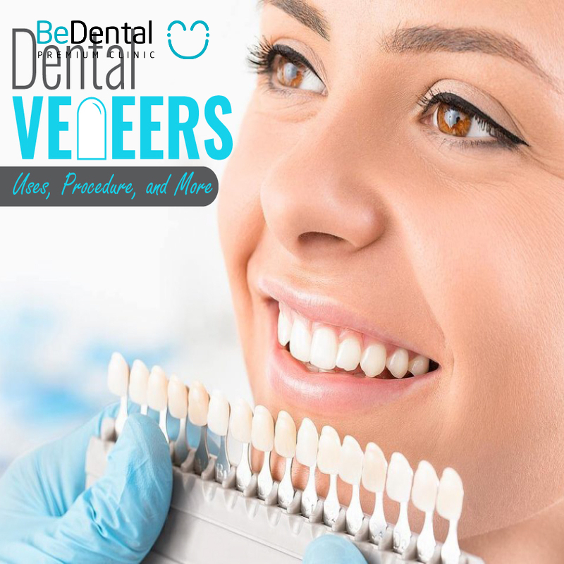 What are dental veneers?