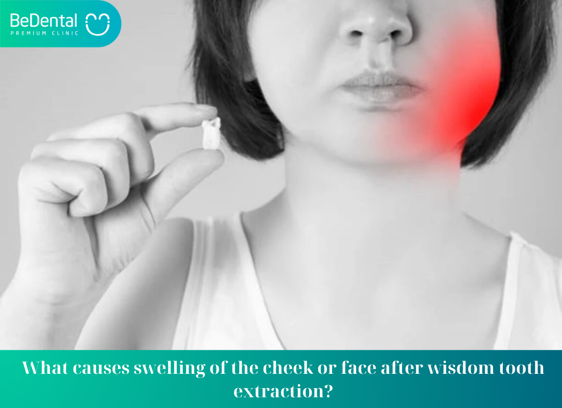 What causes swelling of the cheek or face after wisdom tooth