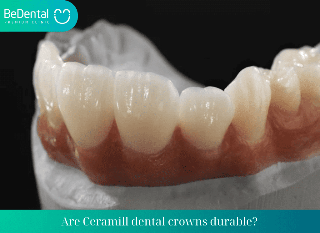 Are Ceramill dental crowns durable