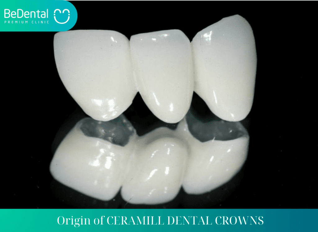 Things to know about ceramill dental crowns