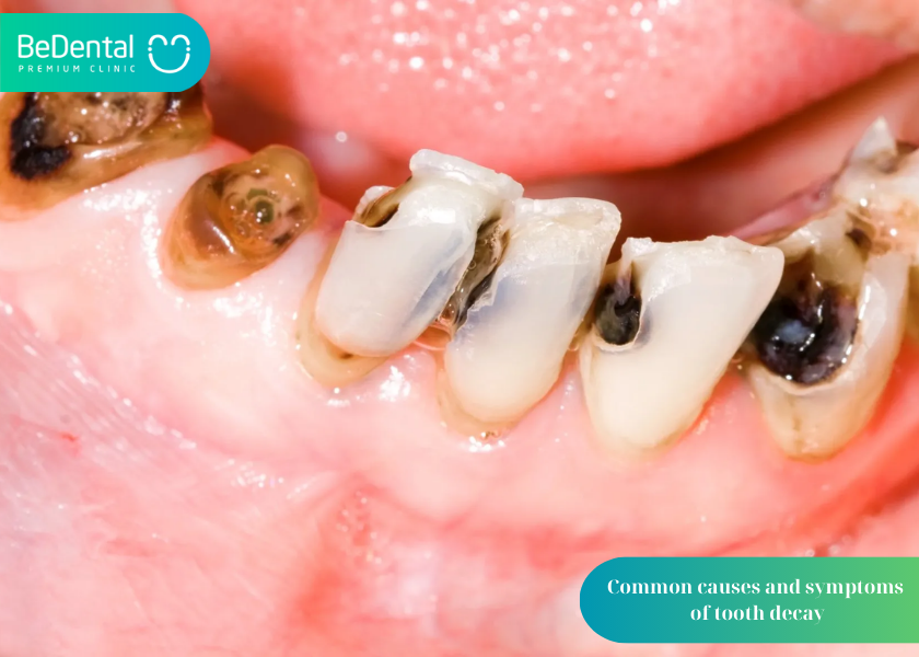 Tooth Decay Treatment in Hanoi: Options, Costs, and Effectiveness 3 Tooth decay treatment in Hanoi