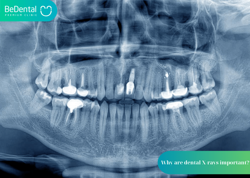 A Guide to Dental X-Rays in Ho Chi Minh City