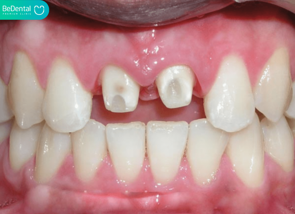 Bọc Răng Sứ 2 Răng Cửa Bao Nhiêu Tiền và Những Điều Cần Biết 3 Bọc răng sứ 2 răng cửa bao nhiêu tiền?