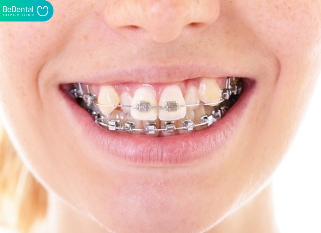 Mất răng có niềng được không?