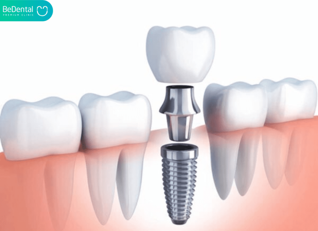 Tru implant Platium