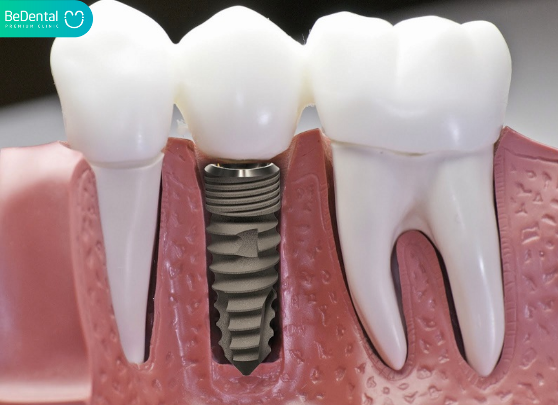Trụ implant là gì?