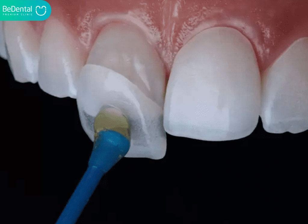 bọc răng sứ bị lệch khớp cắn