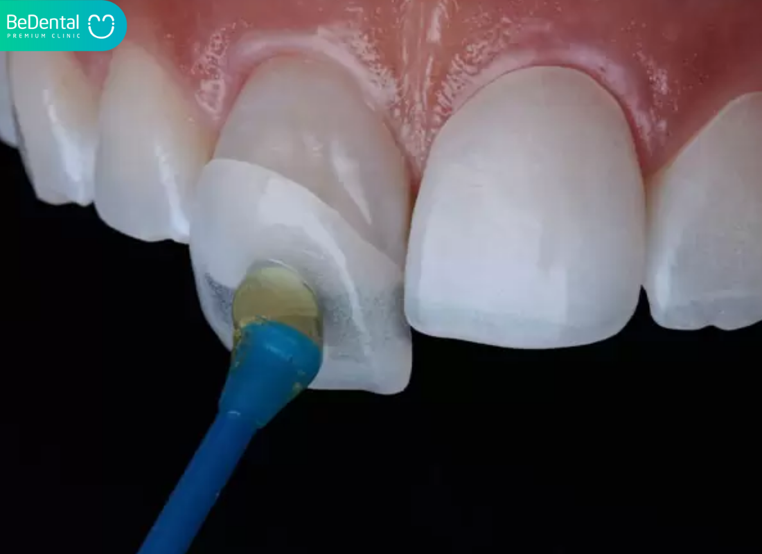 bọc răng sứ bị lệch khớp cắn