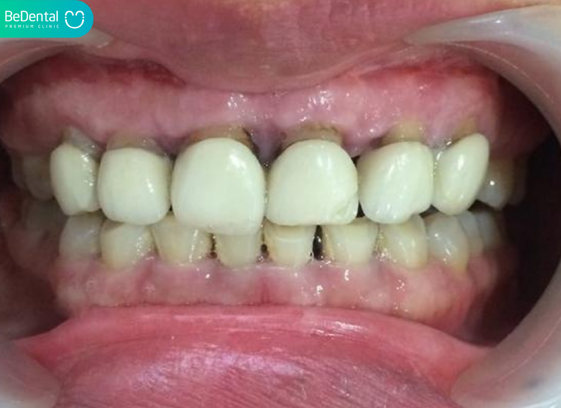 Tác hại của dán răng sứ khi thực hiện sai kỹ thuật 4 Tác hại của dán răng sứ