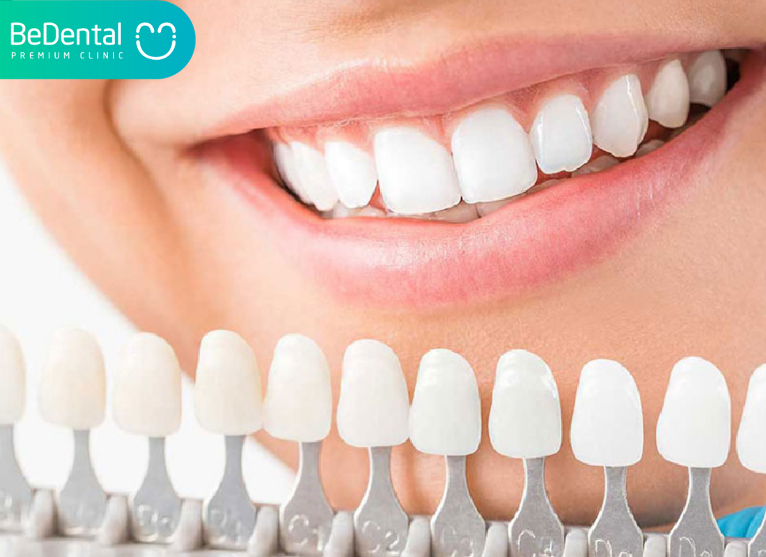 Titanium Porcelain Crowns in Vietnam: Strength, Beauty, and Lasting Value 4 How Titanium Porcelain Crowns Are Made