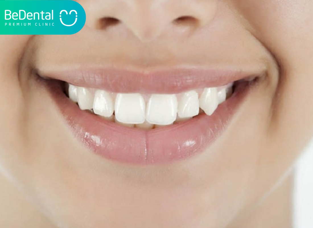 Ưu nhược điểm của việc bọc răng sứ 4 Ưu nhược điểm của việc bọc răng sứ