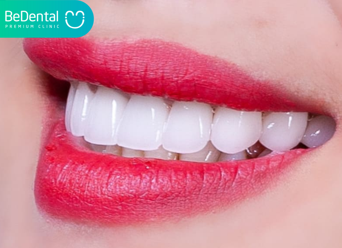 Ưu nhược điểm của việc bọc răng sứ 2 Ưu nhược điểm của việc bọc răng sứ