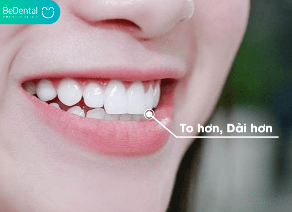 Răng thỏ là gì? Răng thỏ có ý nghĩa và cách tạo hình răng thỏ đẹp chuẩn 4 Dang rang tho 02