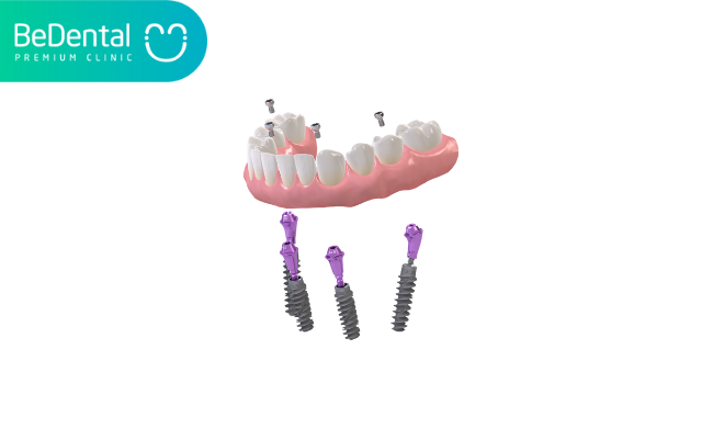 Công nghệ Pro Arch trong trồng răng implant 6 Công nghệ Pro Arch