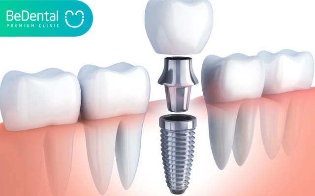 Mất răng bao lâu thì bị tiêu xương hàm?