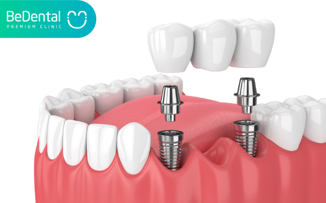 Nhổ răng bao lâu thì trồng implant được? 5 Nhổ răng bao lâu thì trồng implant được?