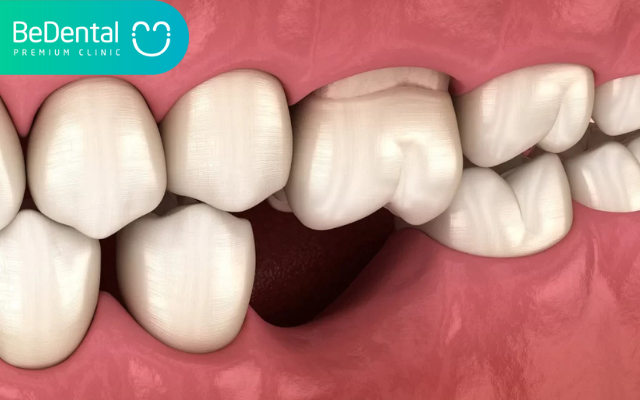 Mất răng bao lâu thì bị tiêu xương hàm?