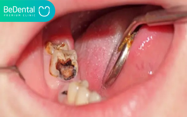 Các cách phòng ngừa sâu răng tại nhà 5 Cách phòng ngừa sâu răng tại nhà