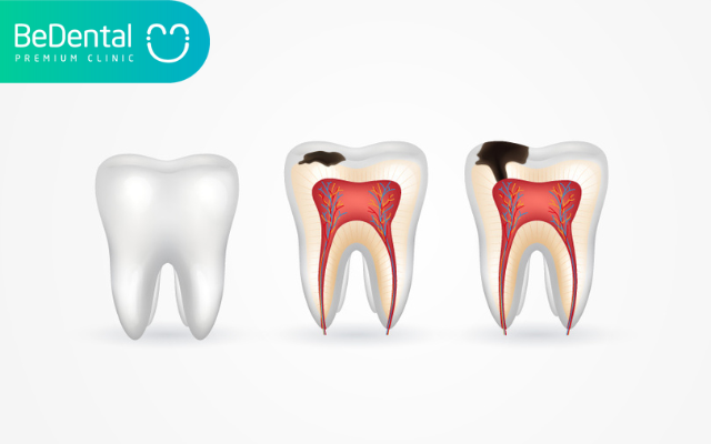 Các cách phòng ngừa sâu răng tại nhà 3 Cách phòng ngừa sâu răng tại nhà