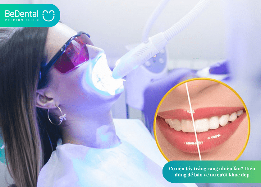How much does teeth whitening cost 1 min 11