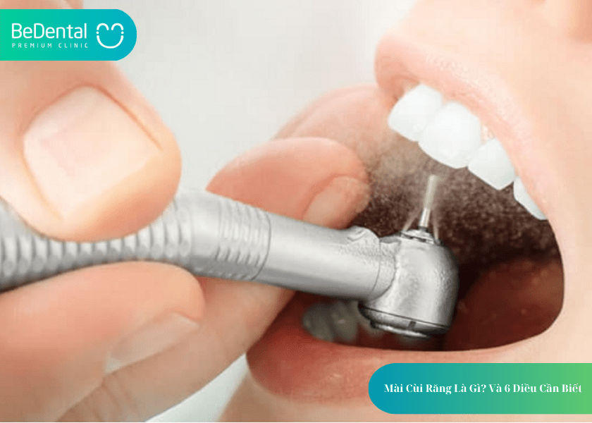 How much does teeth whitening cost 1 min 19