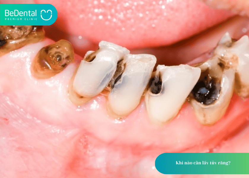 How much does teeth whitening cost 1 min 21