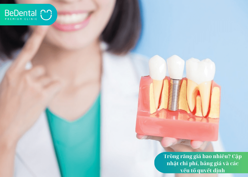 Trồng răng giá bao nhiêu?