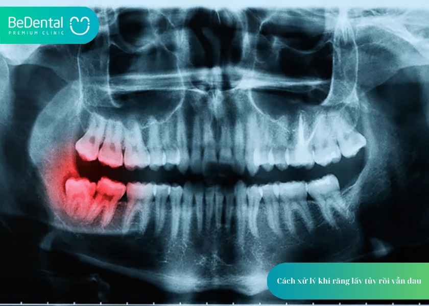 Lấy Tủy Răng Xong Có Đau Không? Chuyên Gia Giải Đáp Từ A–Z 5 How much does teeth whitening cost 1 min 9