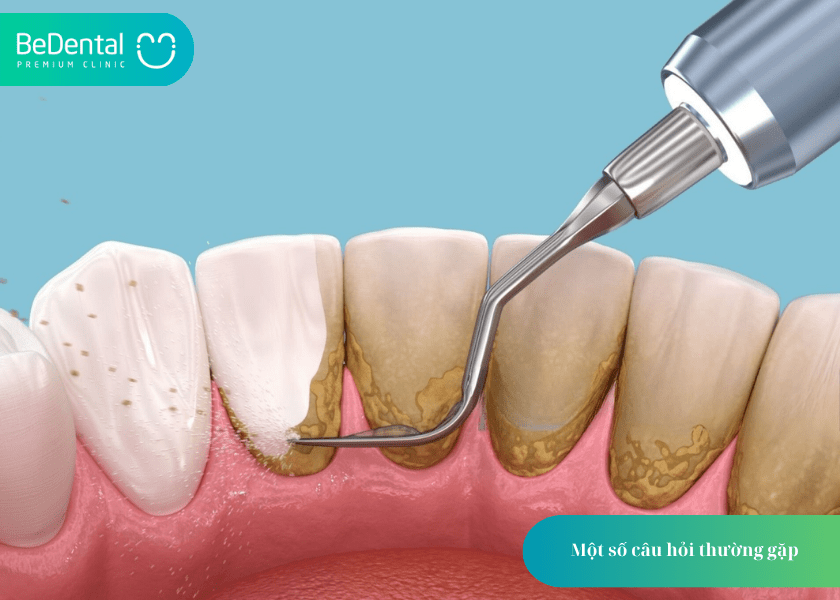 How much does teeth whitening cost 10 min 1