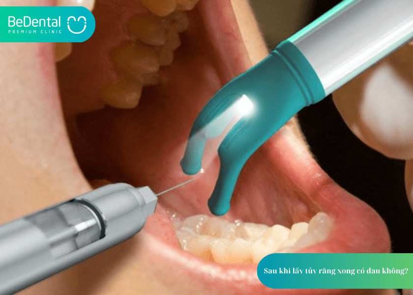 Lấy Tủy Răng Xong Có Đau Không? Chuyên Gia Giải Đáp Từ A–Z 2 How much does teeth whitening cost 12 min 1