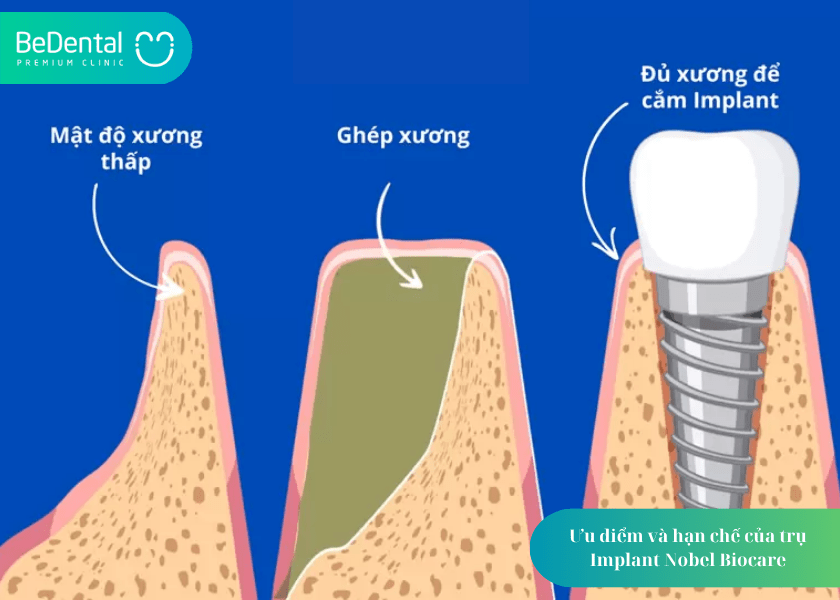 Implant Nobel Biocare và 4 điều cần biết 3 How much does teeth whitening cost 12 min
