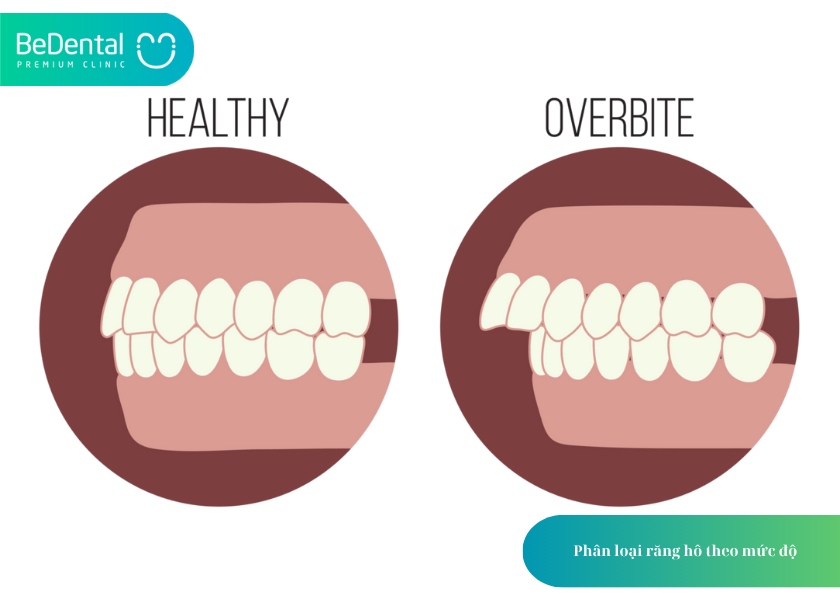Niềng răng hô mất bao lâu? Phân loại và chi phí chi tiết từ A đến Z 2 How much does teeth whitening cost 12