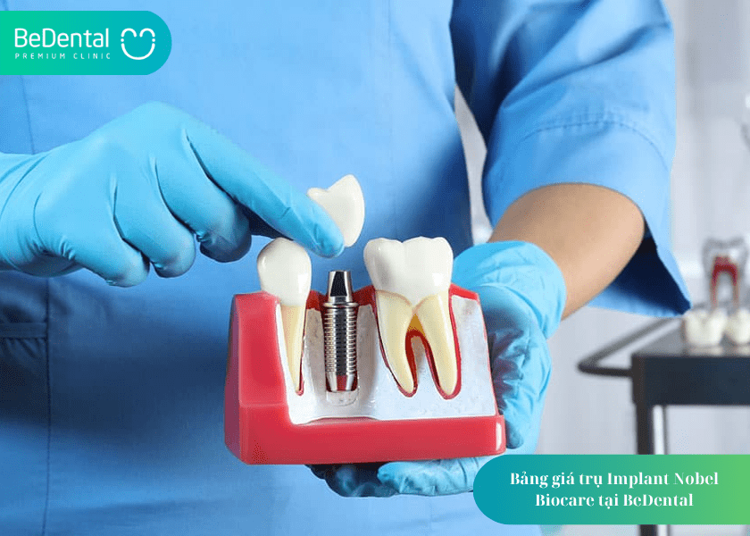 Implant Nobel Biocare và 4 điều cần biết 4 How much does teeth whitening cost 13 min