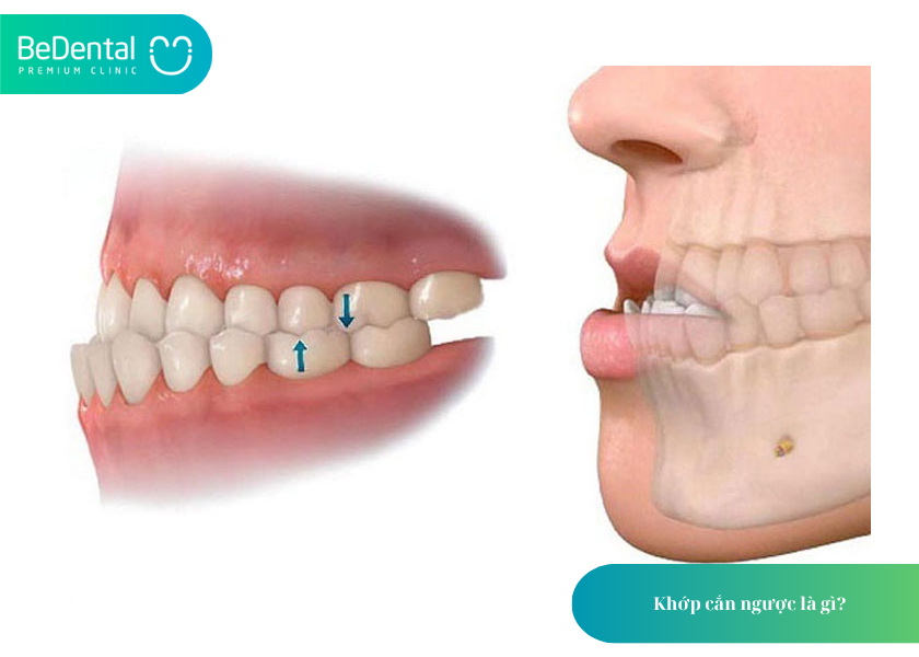 Chi phí điều trị khớp cắn ngược