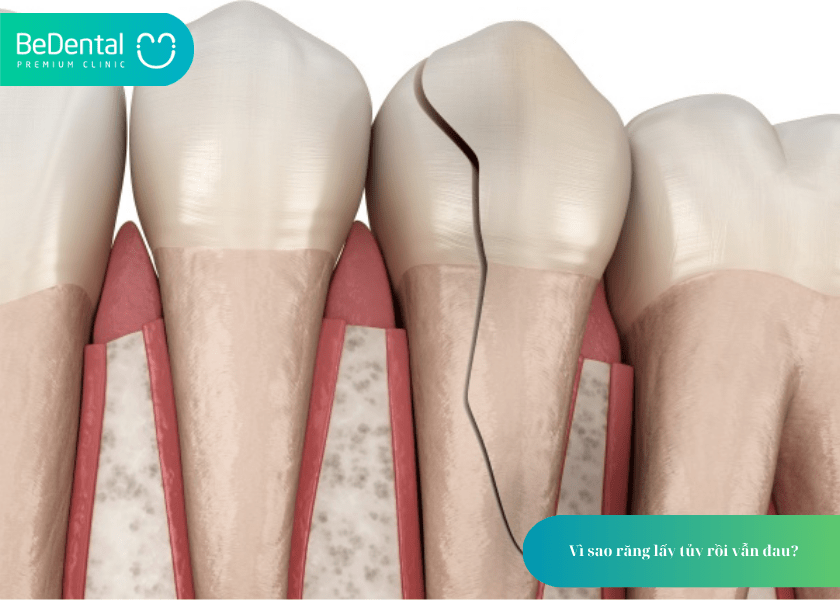 Lấy Tủy Răng Xong Có Đau Không? Chuyên Gia Giải Đáp Từ A–Z 4 How much does teeth whitening cost 14 min