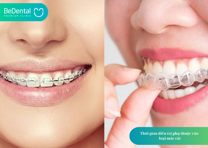 Niềng răng hô mất bao lâu? Phân loại và chi phí chi tiết từ A đến Z 5 Niềng răng hô mất bao lâu?