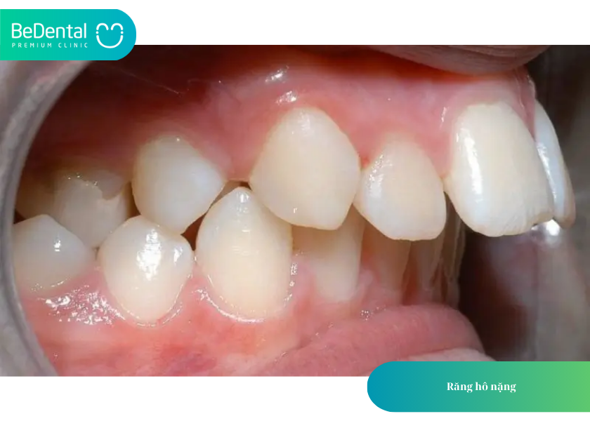 Niềng răng hô mất bao lâu? Phân loại và chi phí chi tiết từ A đến Z 3 How much does teeth whitening cost 16