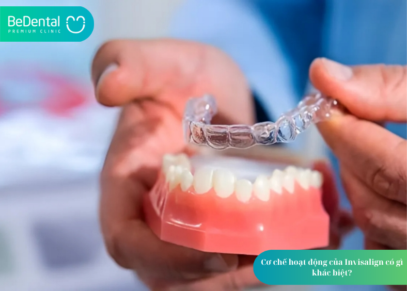 Niềng răng Invisalign có hiệu quả không? Góc nhìn chuyên môn và trải nghiệm thực tế 2 Niềng răng Invisalign có hiệu quả không