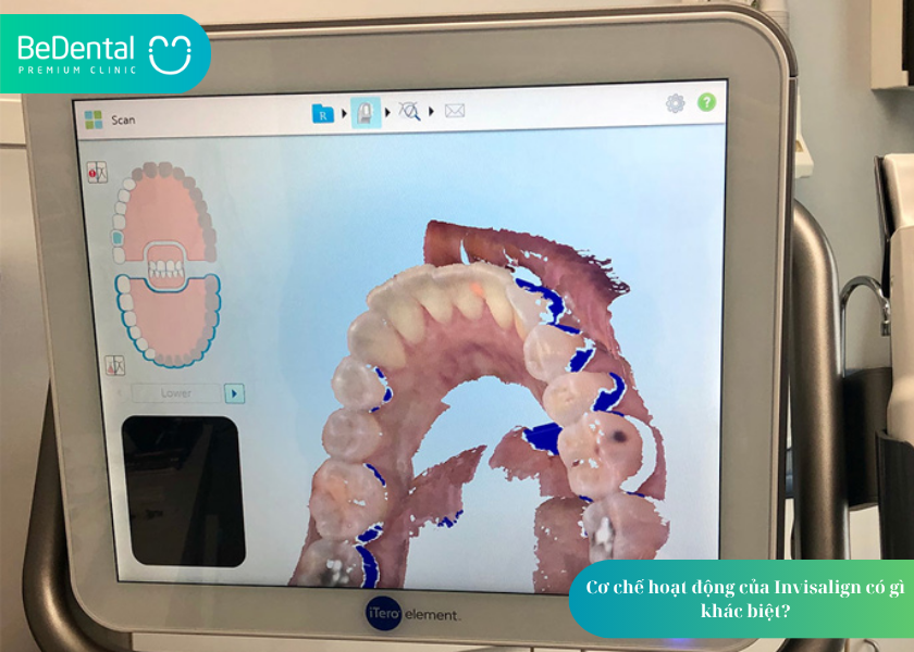 Niềng răng Invisalign có hiệu quả không? Góc nhìn chuyên môn và trải nghiệm thực tế 3 How much does teeth whitening cost 19