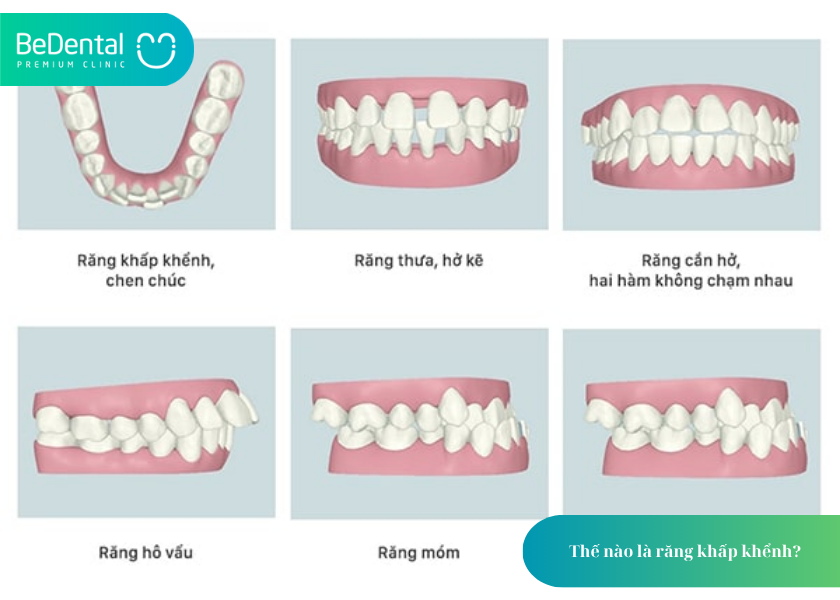 Niềng răng khấp khểnh và 4 điều bạn cần biết 2 How much does teeth whitening cost 2 3