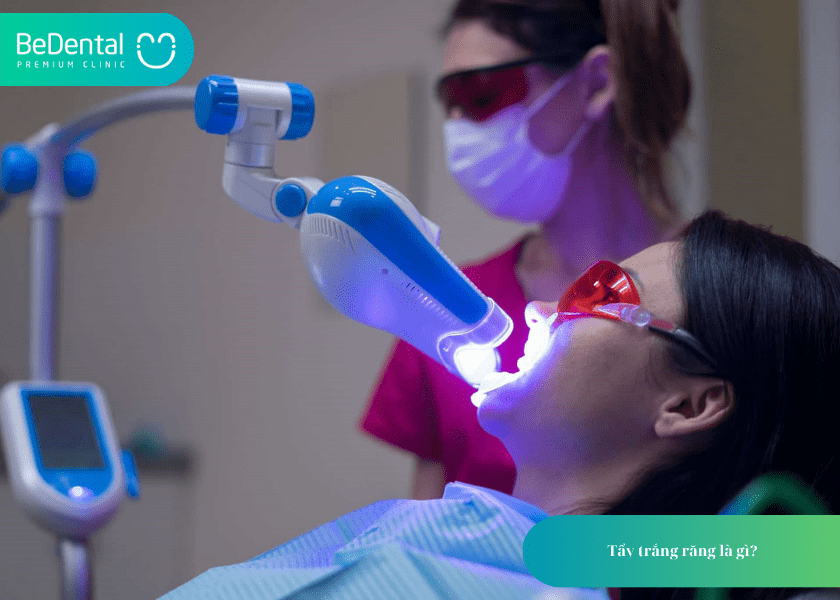 Có nên tẩy trắng răng nhiều lần? Hiểu đúng để bảo vệ nụ cười khỏe đẹp 2 Có nên tẩy trắng răng nhiều lần?