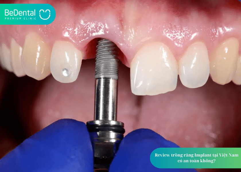 Review trồng răng Implant tại Việt Nam 2 Review trồng răng Implant