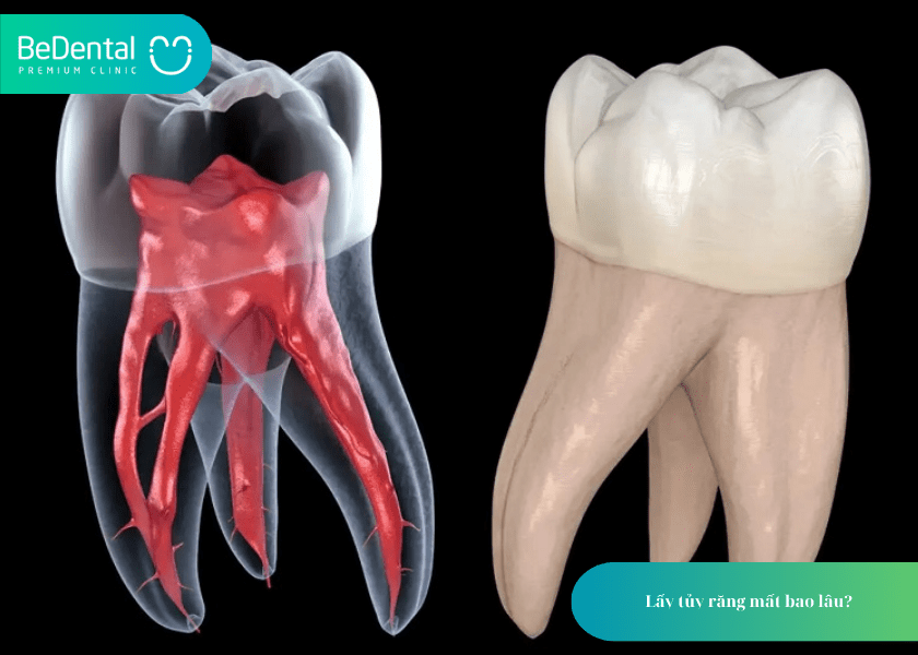 Lấy tủy răng mất bao lâu?